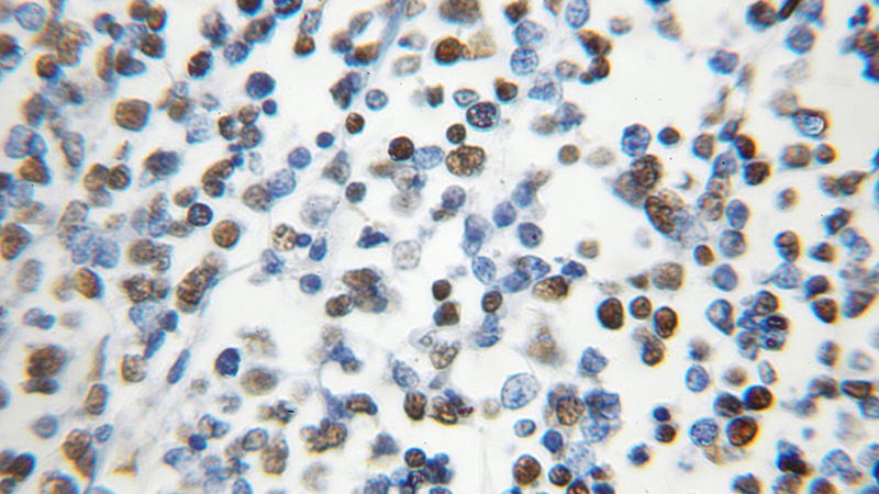 Immunohistochemical of paraffin-embedded human lymphoma using Catalog No:111503(HNRNPC antibody) at dilution of 1:100 (under 10x lens)