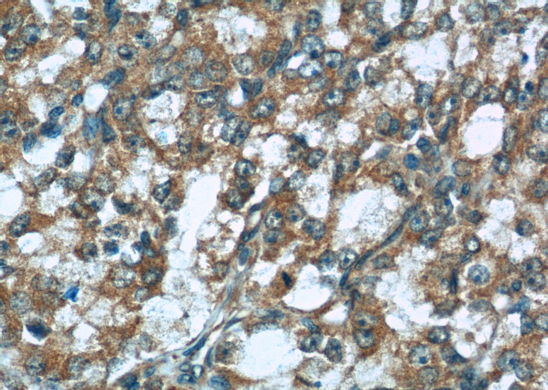 Immunohistochemistry of paraffin-embedded human prostate cancer tissue slide using Catalog No:107493(RABEP2 Antibody) at dilution of 1:50 (under 40x lens)