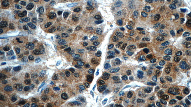 Immunohistochemistry of paraffin-embedded human liver cancer tissue slide using Catalog No:110799(FUT4 Antibody) at dilution of 1:100 (under 40x lens)