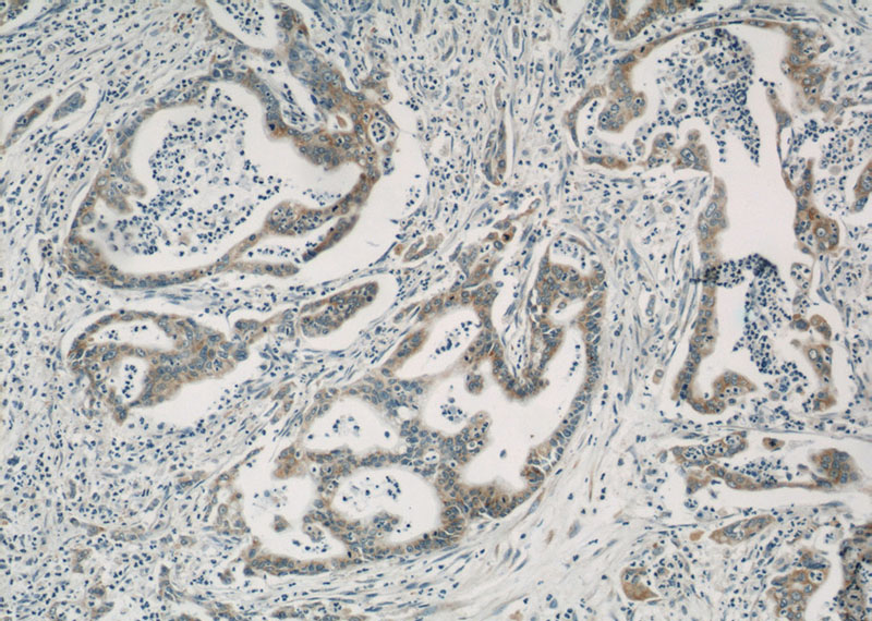Immunohistochemical of paraffin-embedded human pancreas cancer using Catalog No:107225(PPIB antibody) at dilution of 1:50 (under 10x lens)