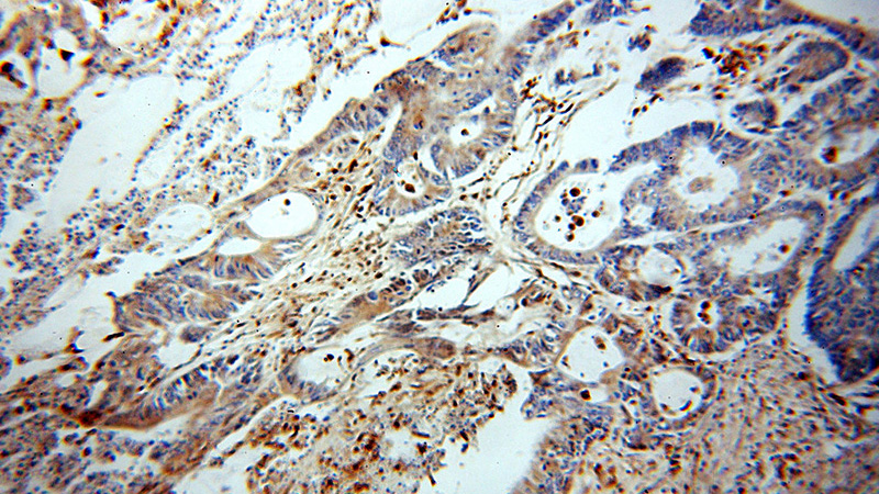 Immunohistochemical of paraffin-embedded human ovary tumor using Catalog No:113672(PD-ECGF antibody) at dilution of 1:50 (under 10x lens)