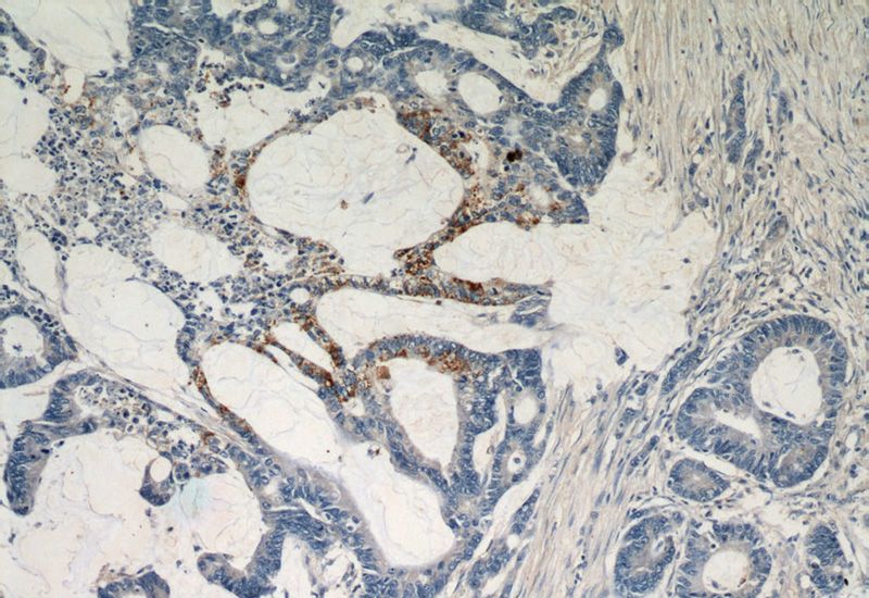Immunohistochemical of paraffin-embedded human colon cancer using Catalog No:114661(RHOF antibody) at dilution of 1:50 (under 10x lens)