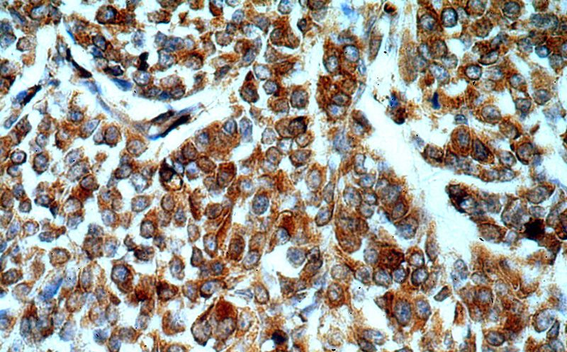 Immunohistochemical of paraffin-embedded human colon cancer using Catalog No:116452(TXNDC5 antibody) at dilution of 1:100 (under 40x lens)