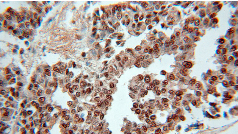 Immunohistochemical of paraffin-embedded human breast cancer using Catalog No:114904(RPLP0 antibody) at dilution of 1:50 (under 10x lens)