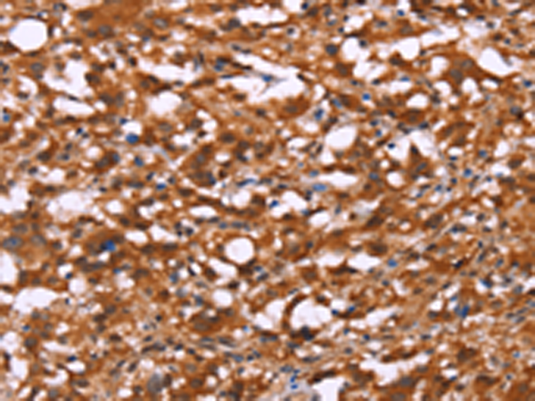 The image is immunohistochemistry of paraffin-embedded Human thyroid cancer tissue using 167526(BRK1 Antibody) at dilution 1/40, on the right is treated with synthetic peptide. (Original magnification: ×200)