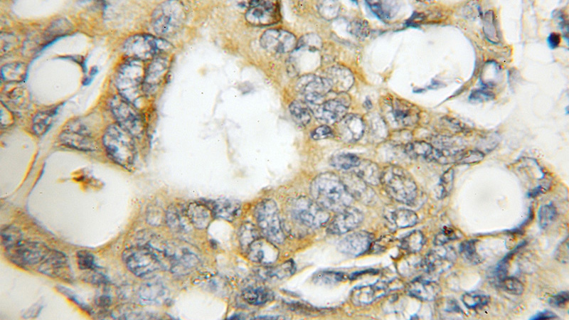 Immunohistochemical of paraffin-embedded human colon cancer using Catalog No:111820(IPO4 antibody) at dilution of 1:50 (under 10x lens)