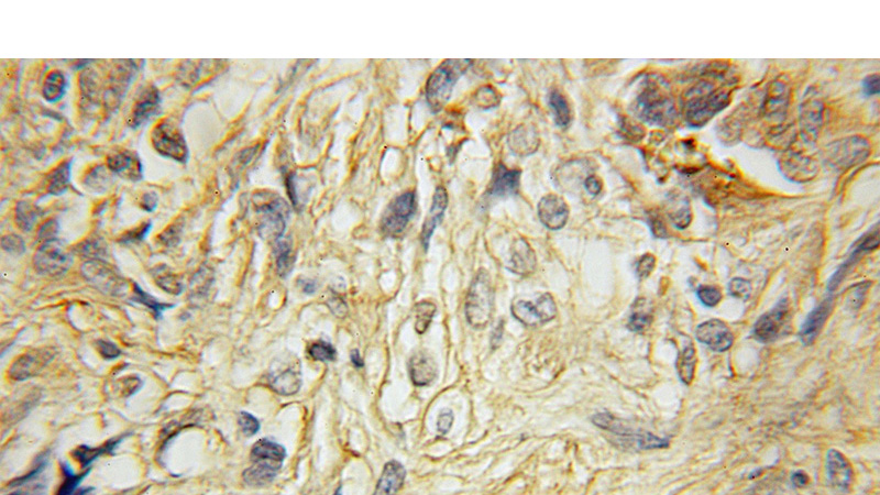Immunohistochemical of paraffin-embedded human gliomas using Catalog No:114449(RAB40B antibody) at dilution of 1:50 (under 10x lens)