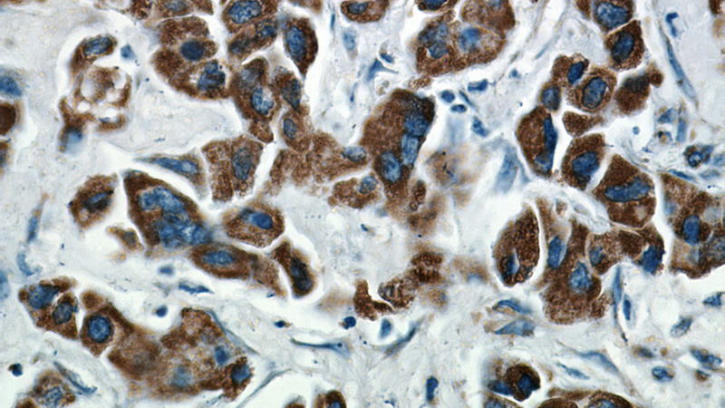 Immunohistochemical of paraffin-embedded human breast cancer using Catalog No:110731(FMO5-specific antibody) at dilution of 1:50 (under 40x lens)