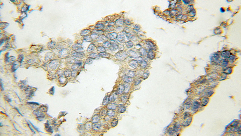 Immunohistochemical of paraffin-embedded human breast cancer using Catalog No:110194(EIF3E antibody) at dilution of 1:50 (under 40x lens)