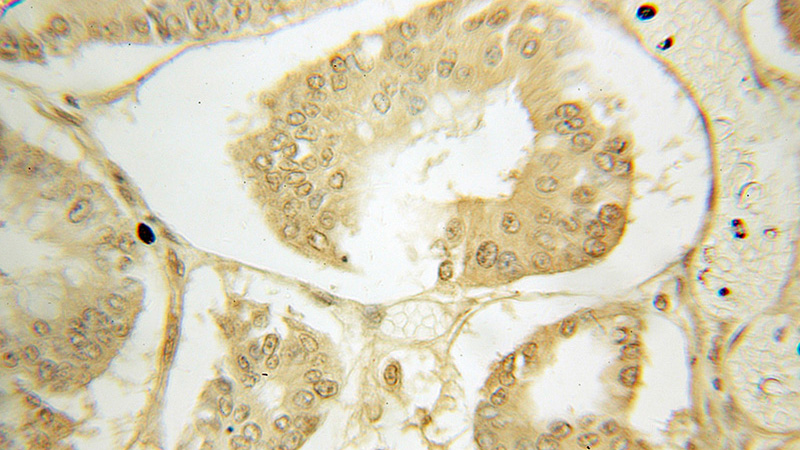Immunohistochemical of paraffin-embedded human colon cancer using Catalog No:116266(TPK1 antibody) at dilution of 1:10 (under 10x lens)