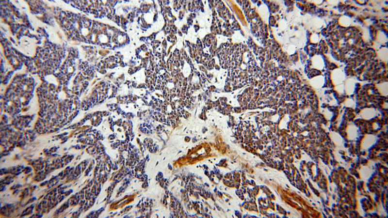 Immunohistochemical of paraffin-embedded human cervical cancer using Catalog No:116654(UBN1-Specific antibody) at dilution of 1:50 (under 10x lens)