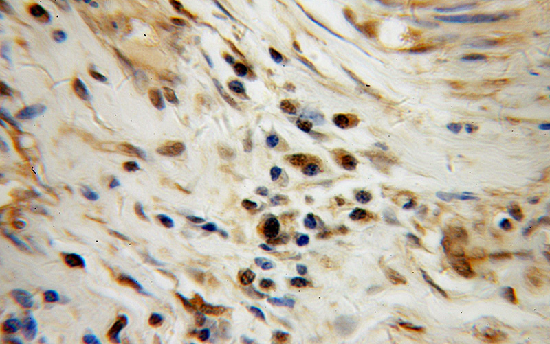Immunohistochemical of paraffin-embedded human cervical cancer using Catalog No:115989(TAF7 antibody) at dilution of 1:100 (under 40x lens)