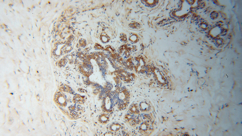 Immunohistochemical of paraffin-embedded human breast cancer using Catalog No:114900(RPL7A antibody) at dilution of 1:100 (under 10x lens)