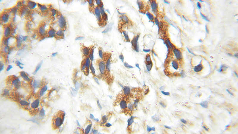 Immunohistochemical of paraffin-embedded human prostate cancer using Catalog No:110334(ENTPD6 antibody) at dilution of 1:100 (under 10x lens)