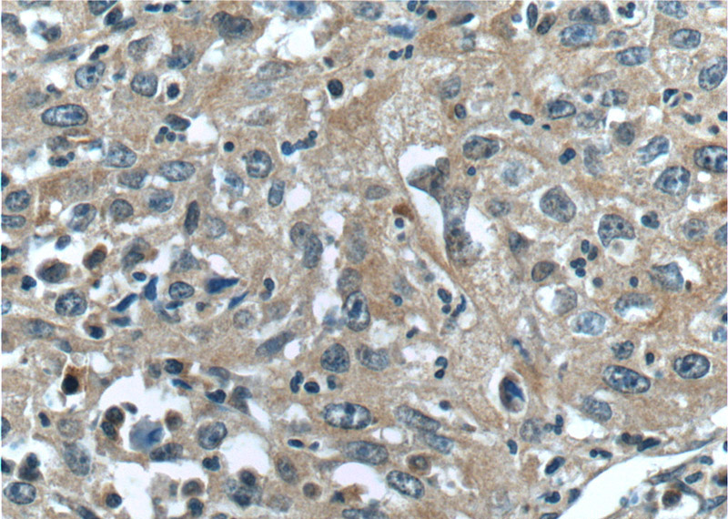 Immunohistochemistry of paraffin-embedded human cervical cancer tissue slide using Catalog No:115969(TACC3 Antibody) at dilution of 1:50 (under 40x lens)