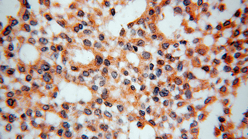 Immunohistochemical of paraffin-embedded human breast cancer using Catalog No:116596(USP2 antibody) at dilution of 1:50 (under 40x lens)