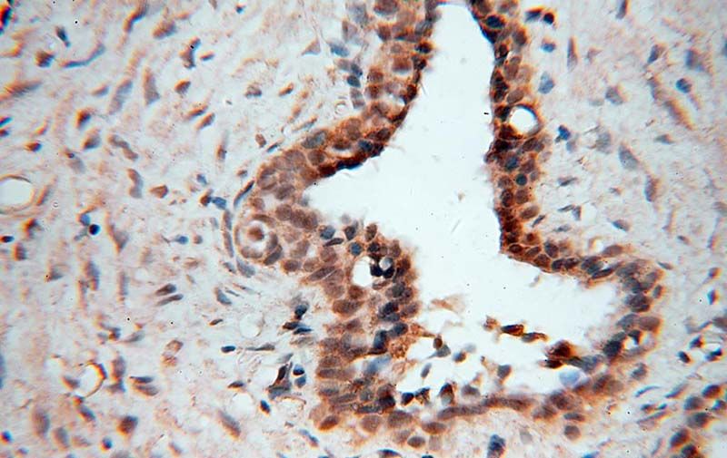 Immunohistochemical of paraffin-embedded human prostate cancer using Catalog No:110410(EXOSC3 antibody) at dilution of 1:50 (under 40x lens)