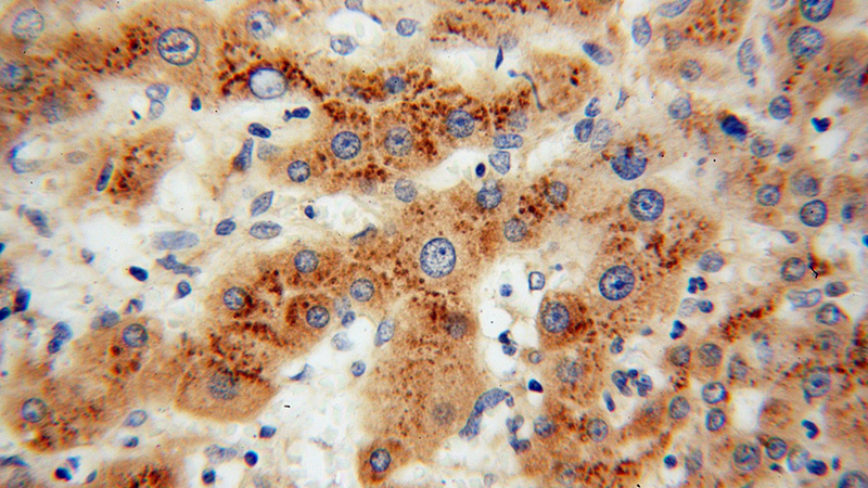 Immunohistochemical of paraffin-embedded human liver cancer using Catalog No:113822(PHKG2 antibody) at dilution of 1:100 (under 40x lens)