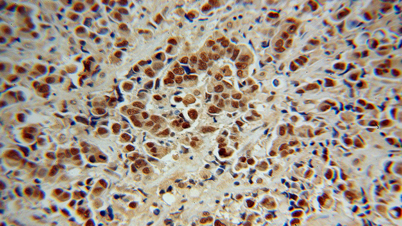 Immunohistochemical of paraffin-embedded human prostate cancer using Catalog No:116306(TRIM24 antibody) at dilution of 1:100 (under 40x lens)