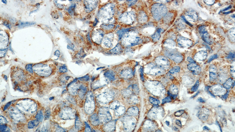 Immunohistochemistry of paraffin-embedded human breast cancer slide using Catalog No:115860 (TAZ Antibody) at dilution of 1:50 (under 40x lens)