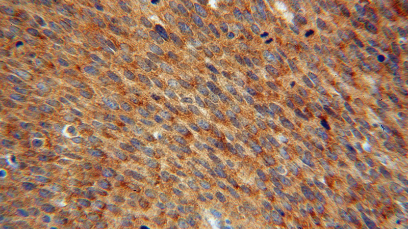 Immunohistochemical of paraffin-embedded human cervical cancer using Catalog No:109475(CORO1C antibody) at dilution of 1:100 (under 40x lens)