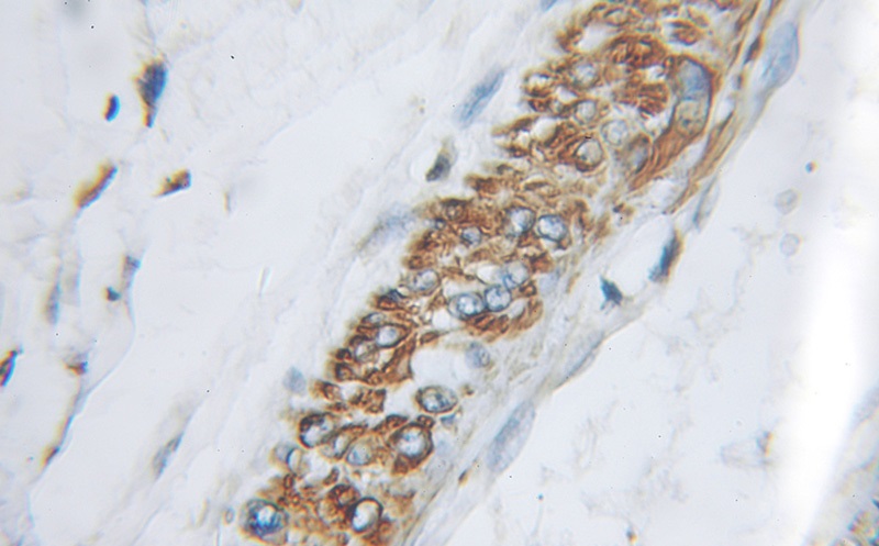 Immunohistochemical of paraffin-embedded human pancreas cancer using Catalog No:108136(APLN antibody) at dilution of 1:100 (under 10x lens)