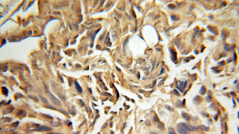 Immunohistochemical of paraffin-embedded human prostate cancer using Catalog No:110558(FBXO7 antibody) at dilution of 1:100 (under 10x lens)