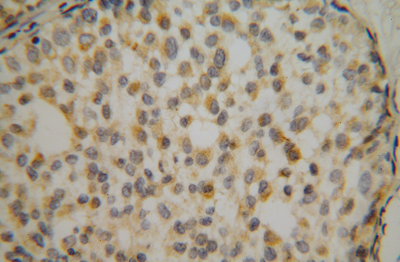 Immunohistochemical of paraffin-embedded human breast cancer using Catalog No:114831(RPS16 antibody) at dilution of 1:50 (under 40x lens)