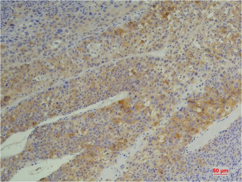 Immunohistochemical analysis of paraffin-embedded Human Heptacarcinoma usingCyclophilin B Mouse mAb diluted at 1:200.