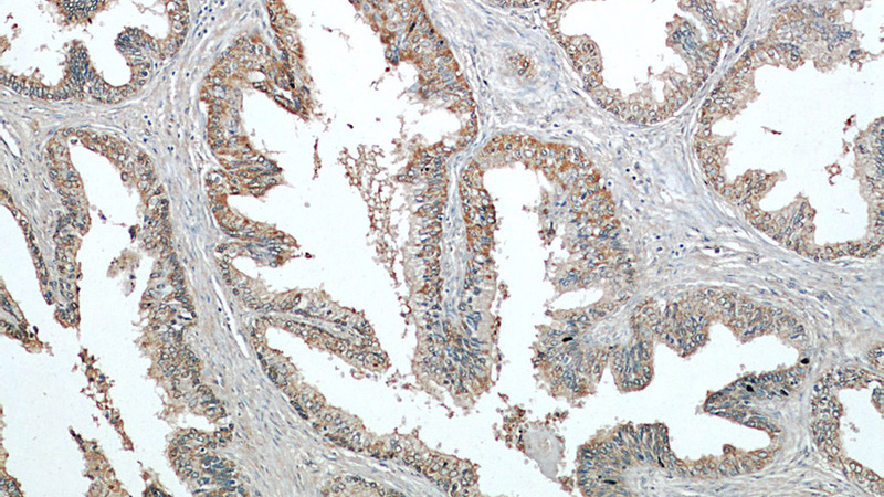 Immunohistochemical of paraffin-embedded human prostate hyperplasia using Catalog No:113322(ODC1 antibody) at dilution of 1:50 (under 10x lens)
