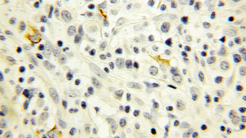 Immunohistochemical of paraffin-embedded human breast cancer using Catalog No:109683(CYP1A1 antibody) at dilution of 1:100 (under 10x lens)