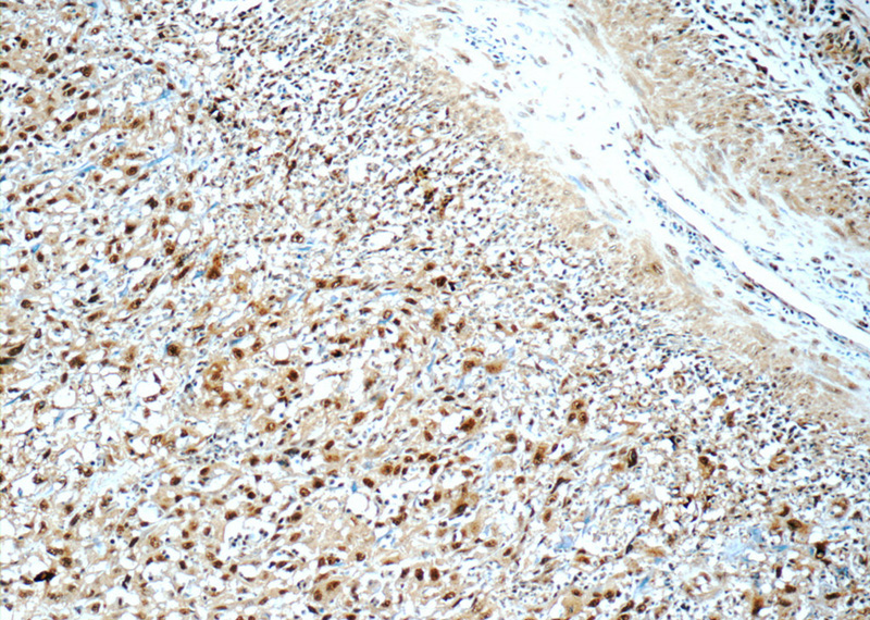 Immunohistochemistry of paraffin-embedded human cervical cancer tissue slide using Catalog No:115456(SNRPA Antibody) at dilution of 1:50 (under 10x lens)