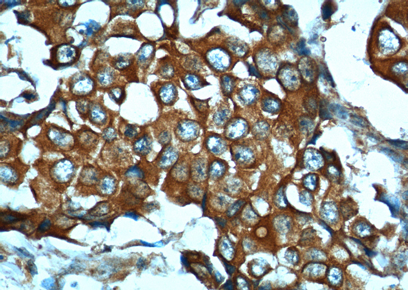 Immunohistochemistry of paraffin-embedded human breast cancer tissue slide using Catalog No:116138(TIMP1 Antibody) at dilution of 1:50 (under 40x lens)