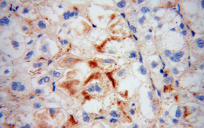 Immunohistochemical of paraffin-embedded human liver cancer using Catalog No:116238(TRAK2 antibody) at dilution of 1:100 (under 40x lens)