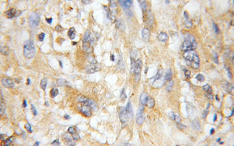 Immunohistochemical of paraffin-embedded human gliomas using Catalog No:113255(NMT1 antibody) at dilution of 1:50 (under 10x lens)