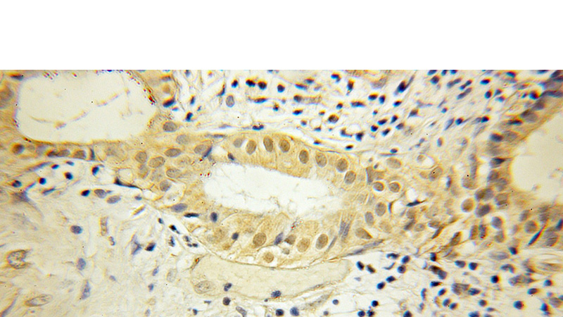 Immunohistochemical of paraffin-embedded human pancreas cancer using Catalog No:115265(SHC1 antibody) at dilution of 1:50 (under 10x lens)