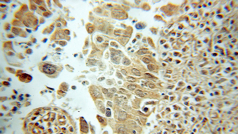 Immunohistochemical of paraffin-embedded human cervical cancer using Catalog No:114541(RANBP9 antibody) at dilution of 1:50 (under 10x lens)