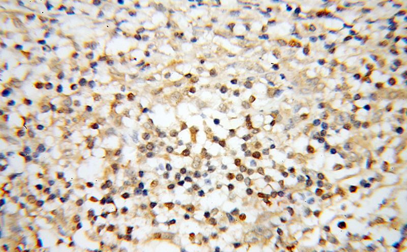 Immunohistochemical of paraffin-embedded human breast cancer using Catalog No:114713(RIOK3 antibody) at dilution of 1:100 (under 40x lens)