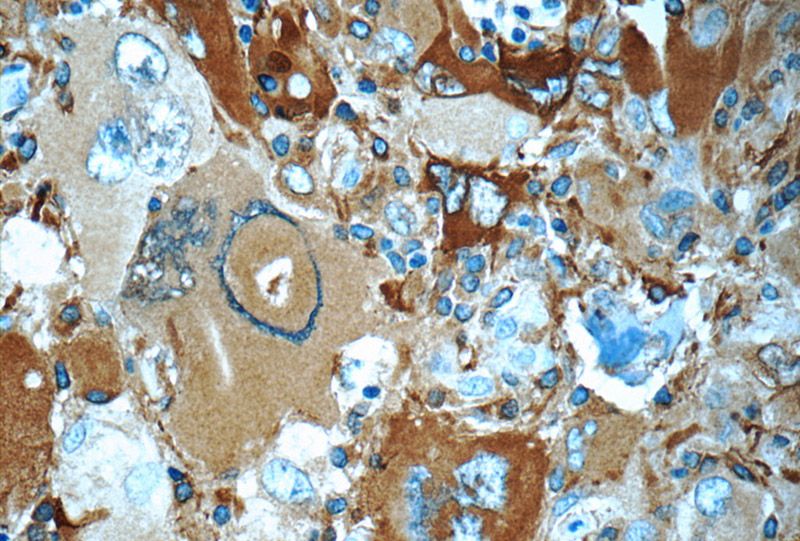 Immunohistochemistry of paraffin-embedded human gliomas tissue slide using Catalog No:113372(NUMBLIKE Antibody) at dilution of 1:50 (under 40x lens)