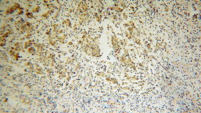 Immunohistochemical of paraffin-embedded human breast cancer using Catalog No:109842(P54 antibody) at dilution of 1:100 (under 10x lens)