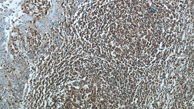 Immunohistochemical of paraffin-embedded human tonsillitis using Catalog No:115269(SHCBP1 antibody) at dilution of 1:50 (under 10x lens)