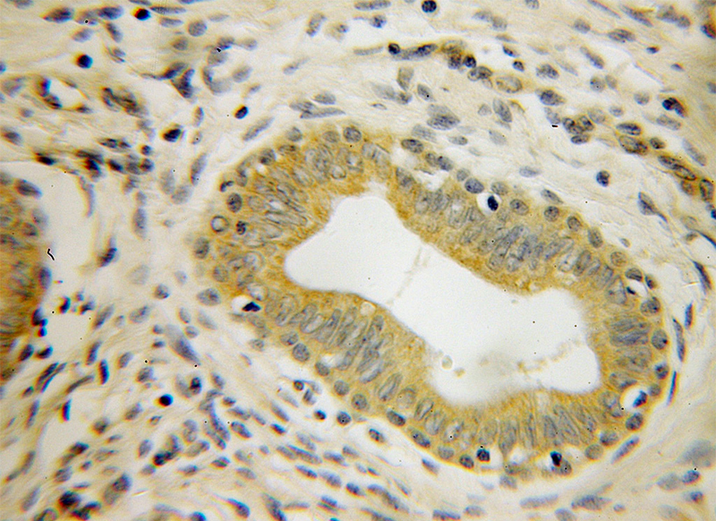 Immunohistochemical of paraffin-embedded human cervical cancer using Catalog No:111097(GMEB2 antibody) at dilution of 1:100 (under 40x lens)