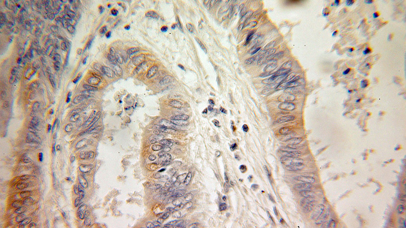 Immunohistochemical of paraffin-embedded human colon cancer using Catalog No:110419(EXTL3 antibody) at dilution of 1:100 (under 25x lens)