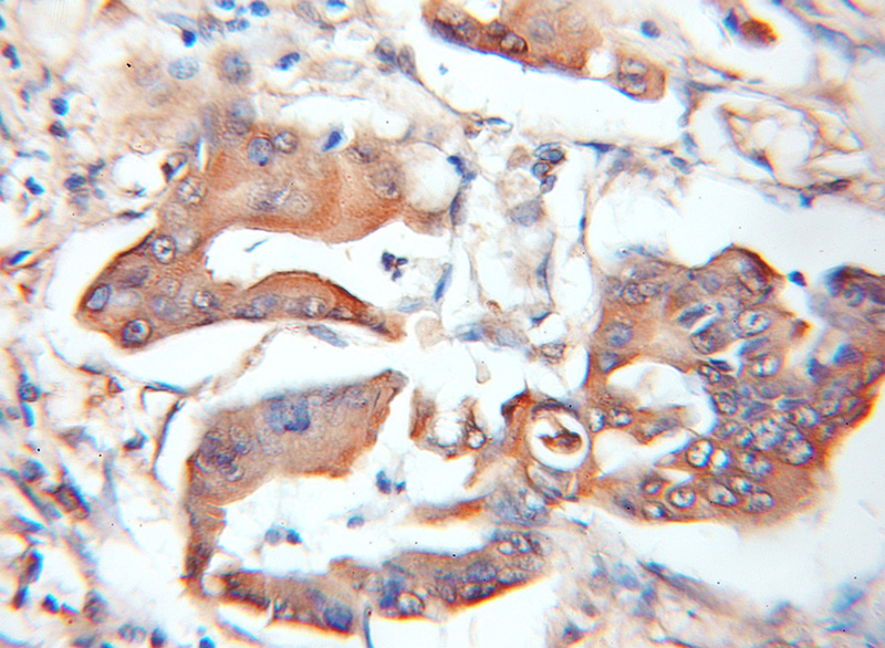 Immunohistochemical of paraffin-embedded human colon cancer using Catalog No:108215(ASB8 antibody) at dilution of 1:100 (under 10x lens)