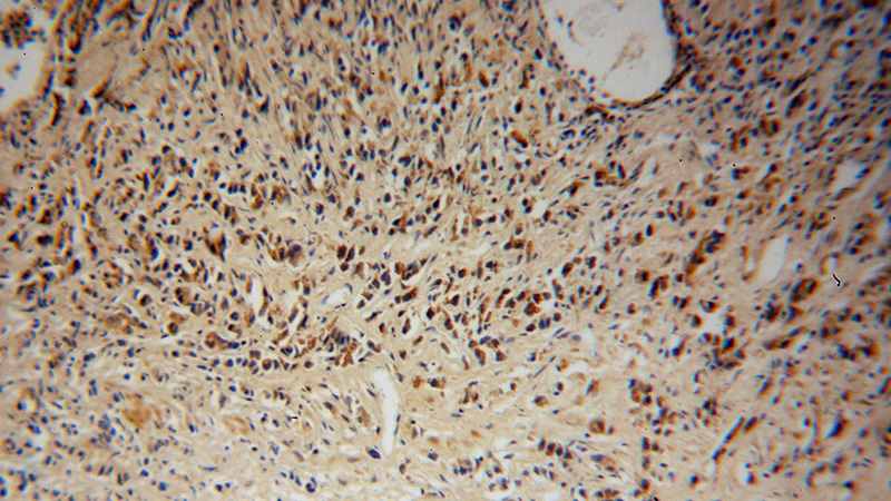 Immunohistochemical of paraffin-embedded human prostate cancer using Catalog No:110052(DOK4 antibody) at dilution of 1:50 (under 10x lens)