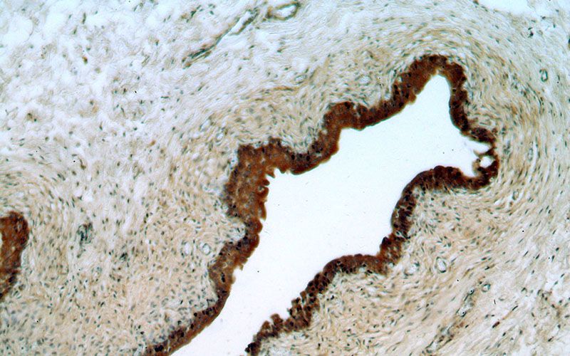 Immunohistochemical of paraffin-embedded human bladder using Catalog No:116017(TGDS antibody) at dilution of 1:50 (under 10x lens)