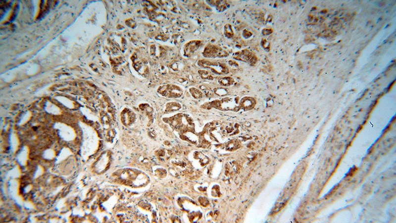 Immunohistochemical of paraffin-embedded human prostate cancer using Catalog No:111013(GNS antibody) at dilution of 1:100 (under 10x lens)