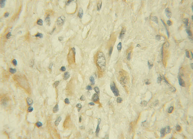 Immunohistochemical of paraffin-embedded human gliomas using Catalog No:116643(URG4 antibody) at dilution of 1:50 (under 10x lens)