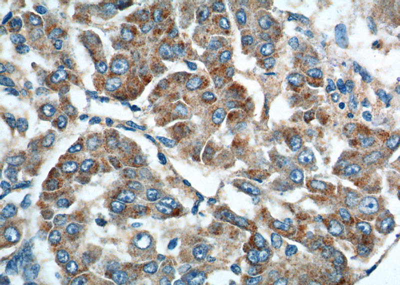 Immunohistochemistry of paraffin-embedded human liver cancer tissue slide using Catalog No:114422(RAB23 Antibody) at dilution of 1:200 (under 40x lens).