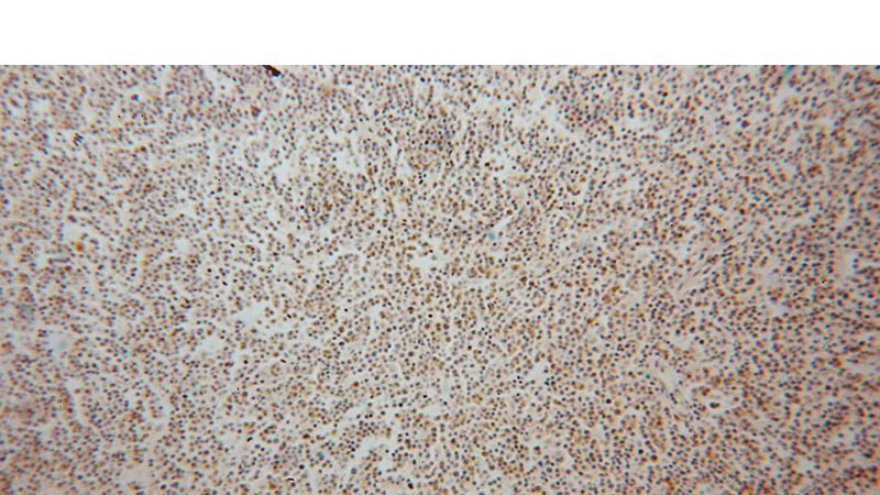 Immunohistochemical of paraffin-embedded human lymphoma using Catalog No:115079(SEC24A antibody) at dilution of 1:50 (under 10x lens)